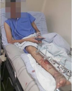 vitima acidente escada rolante Jovem tem perna prensada por escada rolante em shopping