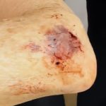 machucado Denúncia de mau atendimento de hospital de Maringá aos servidores públicos