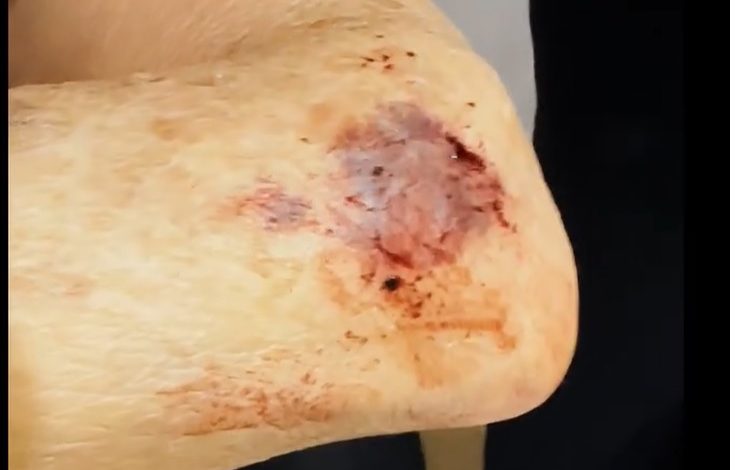 machucado Denúncia de mau atendimento de hospital de Maringá aos servidores públicos